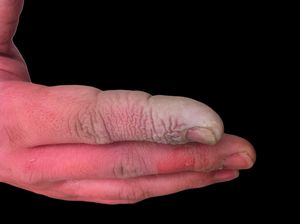 플루오린화 수소산에 의한 손의 화상