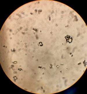 현미경으로 본 소변