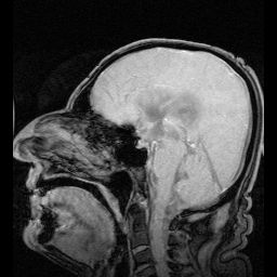 뇌척수액의 흐름을 보여주는 MRI