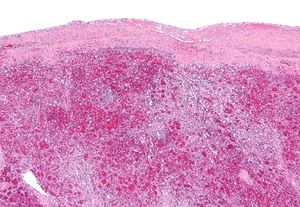 비장 조직의 현미경 사진. 적색 펄프(적색), 백색 펄프(청색)와 두꺼워지고 염증이 있는 피막(주로 분홍색 - 사진 상단)을 보여줍니다. 헤마톡실린-에오신 염색.