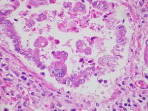 폐소관 내강에 세포 파편과 탈락된 상피세포 응집체가 있는 모습