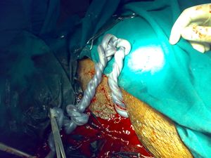 제왕절개 시 쌍둥이 임신에서의 탯줄 엉킴