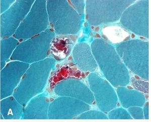 MERRF 증후군 환자의 근육 생검에서 나타난 불균일 적색 근섬유 (화살표로 표시). 수정 고모리 트리크롬 염색.