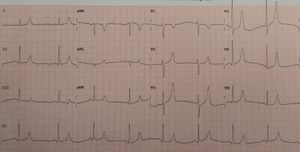 칼륨 수치 5.7인 사람의 심전도(ECG). T파가 크고 P파가 작음