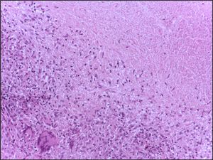 결핵성 육아종 주변에 모여 있는 여러 림프구
