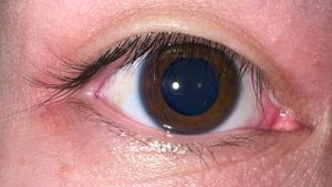 눈꺼풀 피부가 이 사람의 시야에서 중앙 및 안쪽 윗부분의 속눈썹을 아래로 밀어 넣고 있다. 눈꺼풀 바깥 부분의 속눈썹은 위로 말려 올라간다.