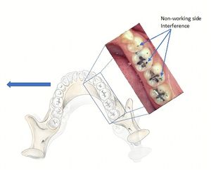 비작업측 간섭(사진): 하악이 왼쪽으로 움직일 때(작업측) 조음 용지 또는 플라스틱 심스톡으로 감지할 수 있다. (애버딘 대학교 치과 연구소)