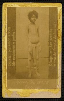 브라질의 1877–78년 그란데 세카(대 가뭄) 기간 중 영양실조에 걸린 아이