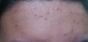 이마에 발생한 땀띠(Miliaria rubra)