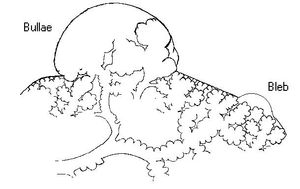 폐 표면에 생긴 블레브의 확대도. 어떤 원인으로 발생하며, 이것이 파열됨으로써 폐가 펑크난다. 자연 기흉의 대부분은 이것이 원인이다.