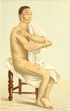 청일 전쟁 중 켈로이드 흉터가 있는 일본 수병. 아시아계는 켈로이드 흉터가 생길 가능성이 더 높은 그룹에 속한다.