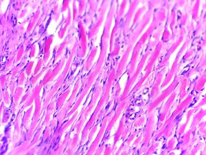 켈로이드의 현미경 사진. 두껍고 유리화된 콜라겐 섬유가 이 비정상적인 치유 과정의 특징이다. H&E 염색.