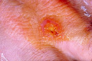 사람의 툴라레미아 병변