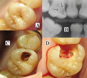 (A) 치아 표면에 보이는 작은 충치 부위. (B) 방사선 사진은 상아질 내의 광범위한 탈회 영역을 보여준다(화살표). (C) 충치 제거를 시작하면서 치아 옆면에 구멍이 발견되었다. (D) 모든 충치를 제거함; 충전 준비 완료.
