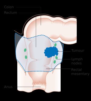 직장암의 국소 수술 다이어그램
