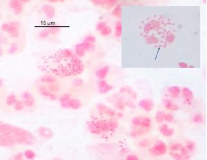 질 분비물 그람 염색에서 임균(쌍으로 - 화살표)이 다형핵 과립구 내부에 나타남