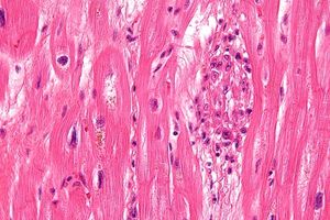 아쇼프 소체 (이미지 오른쪽), H&E 염색