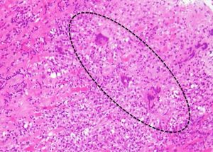 다핵 거대 세포가 있는 거대 세포 심근염.