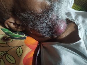 우측 하악각의 염증성 국소 림프절병증