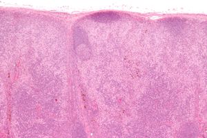 현미경 사진 of 피부병성 림프절병증, 림프절병증의 일종. H&E 염색.