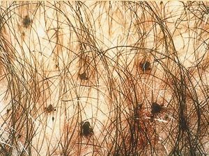 사면발이를 가진 음모