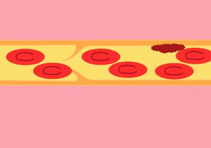 정맥에서 폐쇄성 혈전 형성의 애니메이션. 몇 개의 혈소판이 판막 입술에 부착되어 개구부를 조이고 더 많은 혈소판과 적혈구가 응집하고 응고되도록 합니다. 막힘의 양쪽에서 움직이지 않는 혈액의 응고는 양쪽 방향으로 혈전을 전파할 수 있습니다.