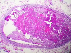 이 폐 혈전색전증은 먼 혈관 벽에서 떨어져 나온 혈전(혈액 응고)의 결과였다. 그런 다음 순환계를 통해 이동하여 이 폐 혈관에 자리 잡고 혈전색전증이 되었다.