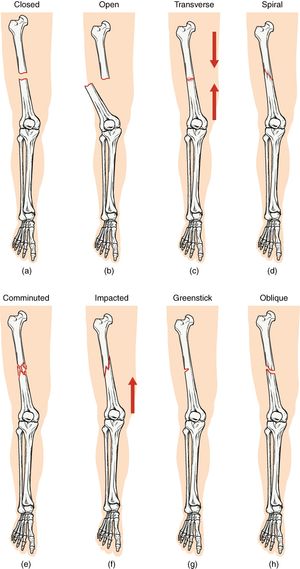 건강한 뼈와 다양한 골절 유형 비교: &nbsp;&nbsp;&nbsp;(a) 폐쇄 골절 &nbsp;&nbsp;&nbsp;(b) 개방 골절 &nbsp;&nbsp;&nbsp;(c) 가로 골절 &nbsp;&nbsp;&nbsp;(d) 나선 골절 &nbsp;&nbsp;&nbsp;(e) 분쇄 골절 &nbsp;&nbsp;&nbsp;(f) 압박 골절 &nbsp;&nbsp;&nbsp;(g) 불완전 골절 &nbsp;&nbsp;&nbsp;(h) 사선 골절