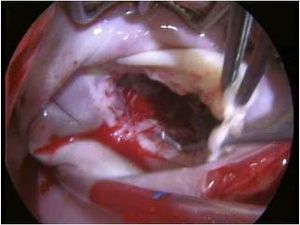 전방 엽의 파열로 인한 승모판의 수술적 시야