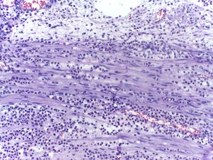 급성 염증 동안 여러 호중구를 보여주는 현미경 사진