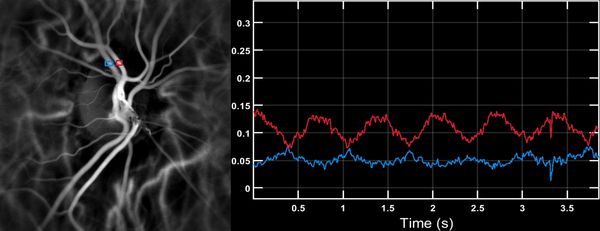 레이저 도플러 영상으로 다카야수 동맥염 환자의 안저에서 측정한 중심 망막 동맥(빨간색) 및 정맥(파란색)의 혈류 펄스 파형