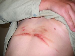 마라톤 후 피부 쓸림