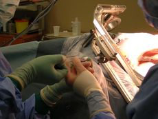 정위적 뇌 생검 사진. 바늘을 통해 진공 시스템으로 종양의 작은 부분을 채취한다.