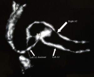 mm}} 크기의 뇌동맥류를 보여주는 CT 혈관 조영술.