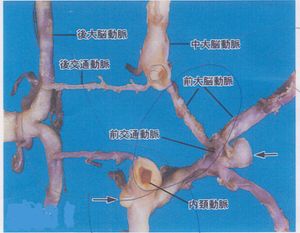 윌리스 고리(뇌동맥륜)와 뇌동맥류가 잘 발생하는 주요 지점들.