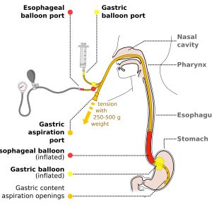 다른 조치가 실패할 경우 식도 출혈을 멈추는 데 사용되는 블레이크모어 식도 풍선