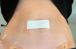 복강경 시술 후 여성의 배꼽.