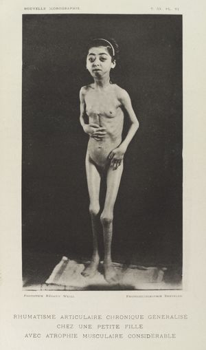 만성 류마티즘을 앓고 있는 17세 소녀의 내인성 질환으로 인한 근위축증