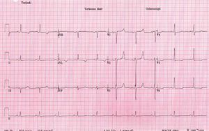저칼슘혈증 환자의 심전도