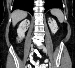 폐 림프관평활근종증 환자의 신장에 있는 여러 개의 혈관근종을 보여주는 컴퓨터 단층 촬영: TSC가 의심됨