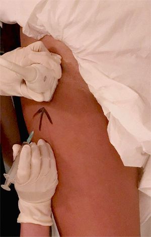 초음파 유도 엉덩이 관절 주사: 바늘의 최적 진입 지점을 표시하기 위해 피부에 표시를 한다.