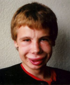  신증후군은 일반적으로 물과 나트륨의 저류를 동반한다. 이러한 현상의 정도는 낮 동안 감소하는 눈꺼풀의 경미한 부종에서 시작하여, 하지에 영향을 미치고, 전신 부종을 거쳐 심한 전신 부종에 이르기까지 다양하게 나타날 수 있다.