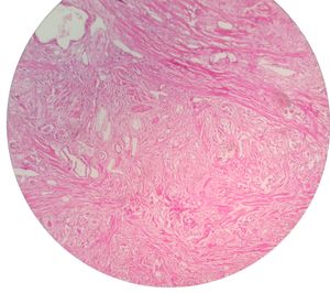 양성 전립선 비대증