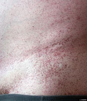 파브리병의 흔한 피부 증상인 혈관각화종