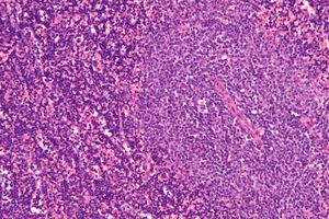 현미경 사진으로 만성 림프구성 백혈병(B-CLL)의 영향을 받은 림프절을 보여준다. 특징적인 증식 중심(이미지 오른쪽)은 더 크고 밝게 염색된 세포로 구성되어 있다. (H&E 염색)