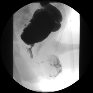 요도 및 방광 확장을 동반한 요로 폐쇄를 나타내는 방광 요도 조영술