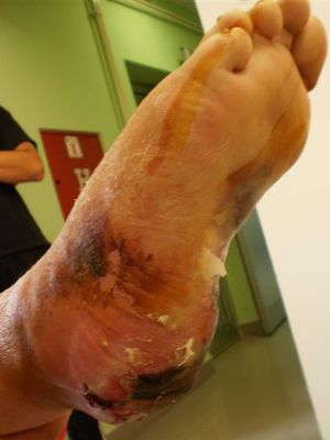 일반적으로 "당뇨병성 발"이라고 불리는 상처와 궤양은 당뇨병에서 혈당 수치 상승의 흔한 합병증이다.