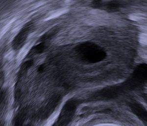 질 초음파로 임신한 여성의 황체를 보여주며, 중심에 체액으로 채워진 공동이 있다.