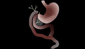 담도 공장 문합술의 도식 다이어그램, 문합 부위 표시