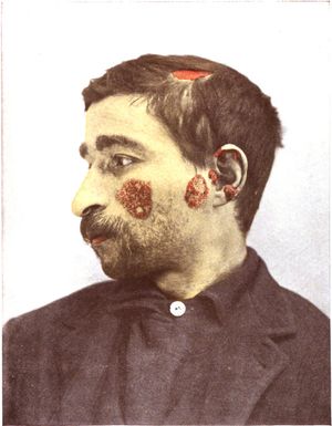 뺨, 귀, 두피의 루푸스 반점